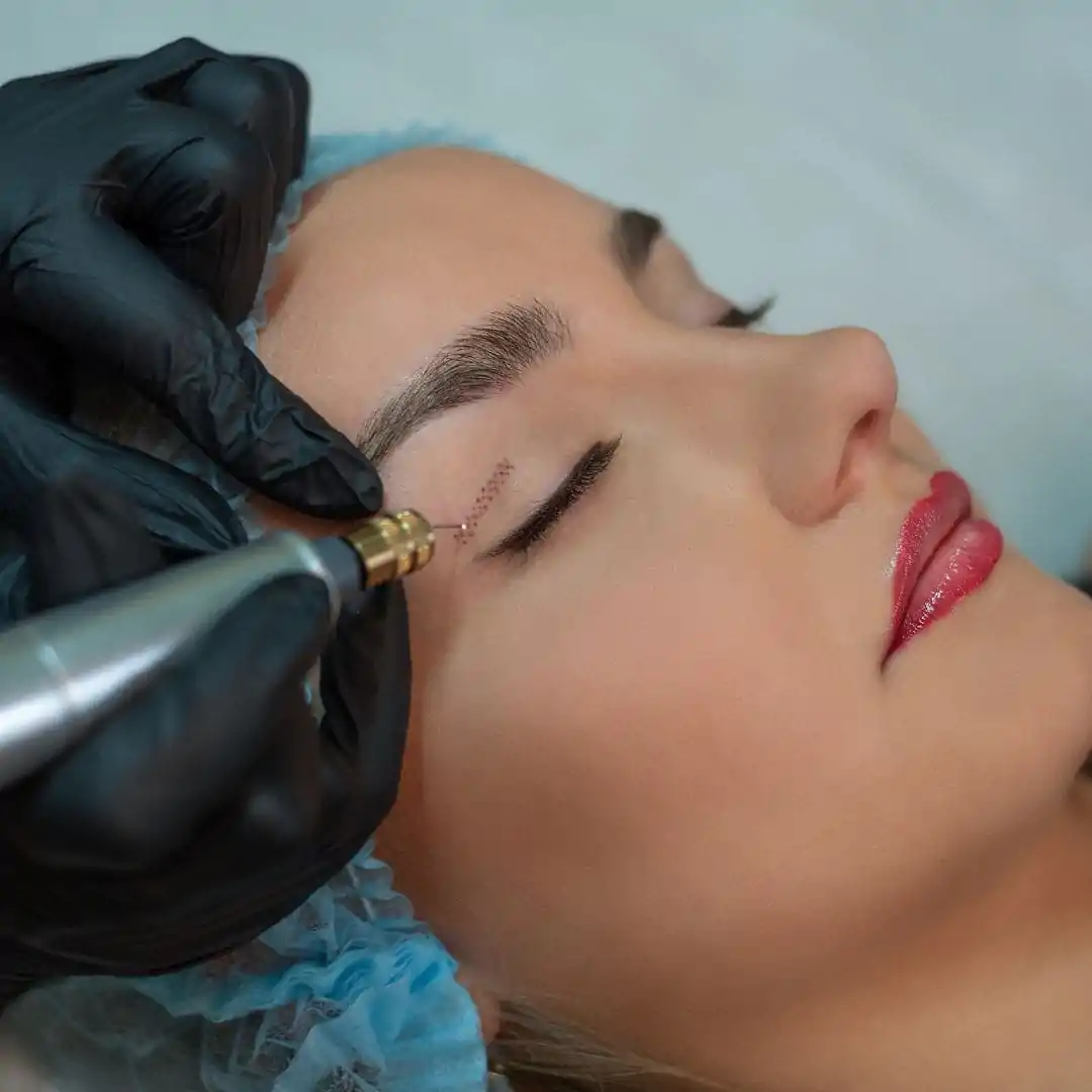 Blefaroplastia sem Corte